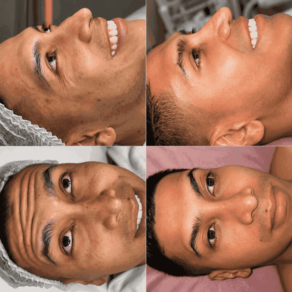 Antes y después — limpieza facial en hombre, Kzalon Cali