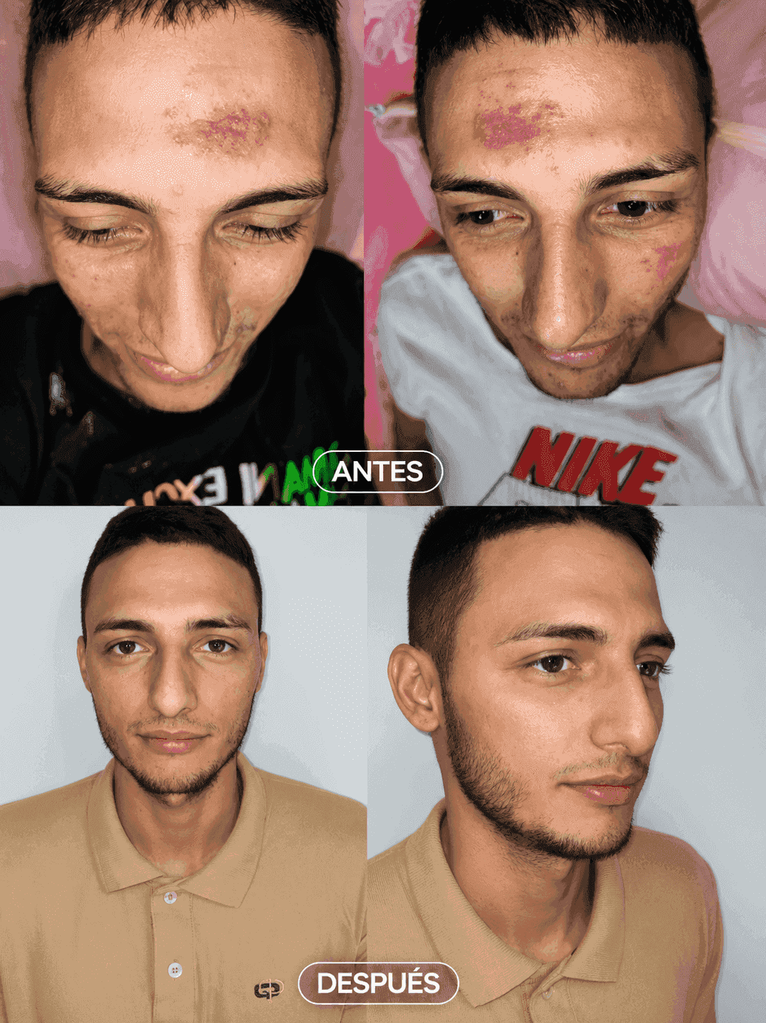 Antes y después — tratamiento de acné e hiperpigmentación en Kzalon, Cali