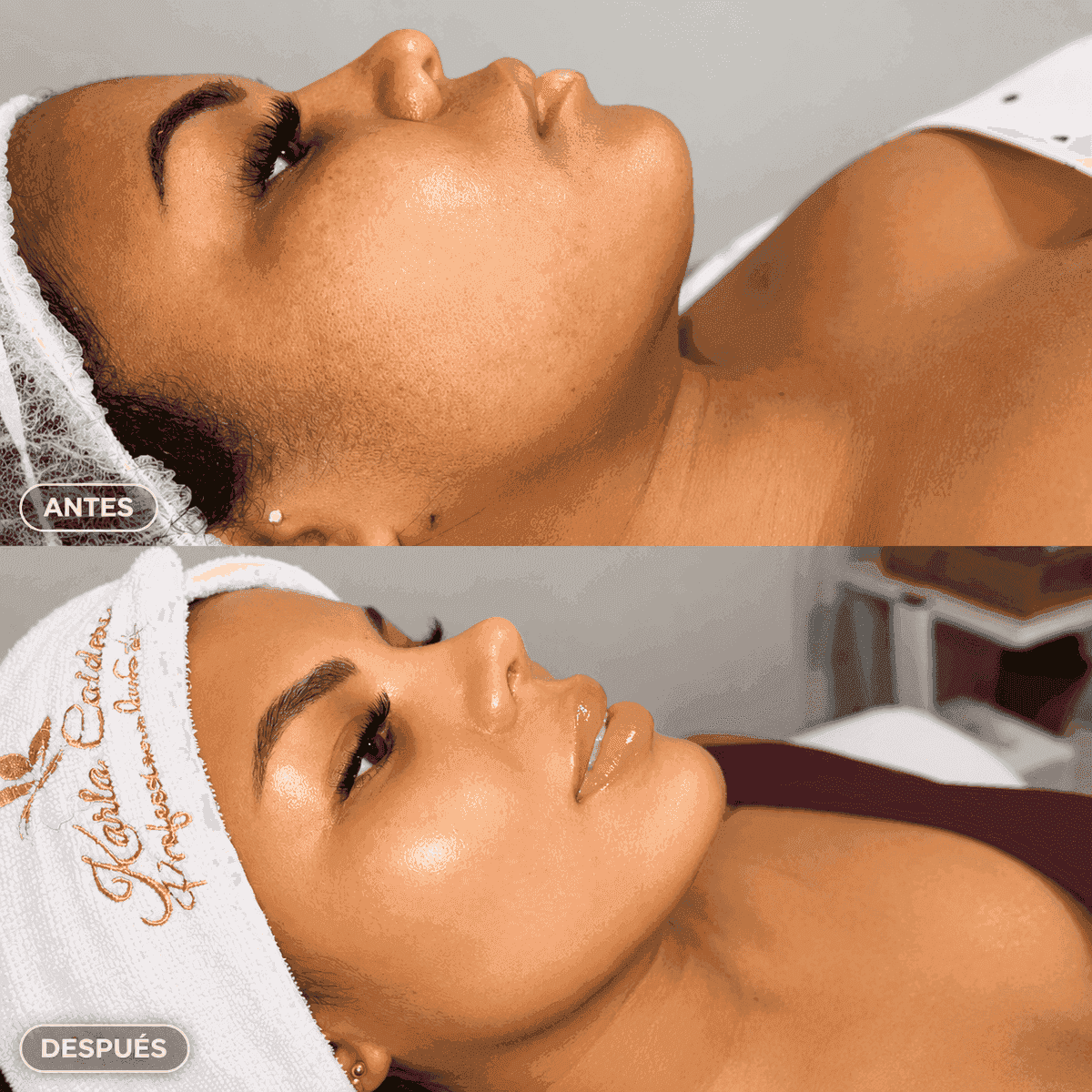 Antes y después — tratamiento facial e hidratación profunda en Kzalon Cali