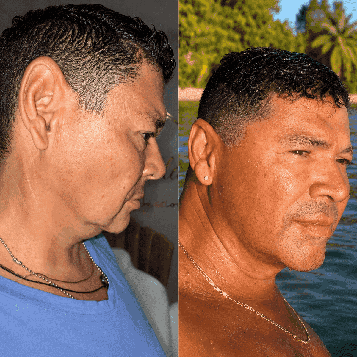 Antes y después — mejora de textura y tono de piel en hombre, Kzalon Cali