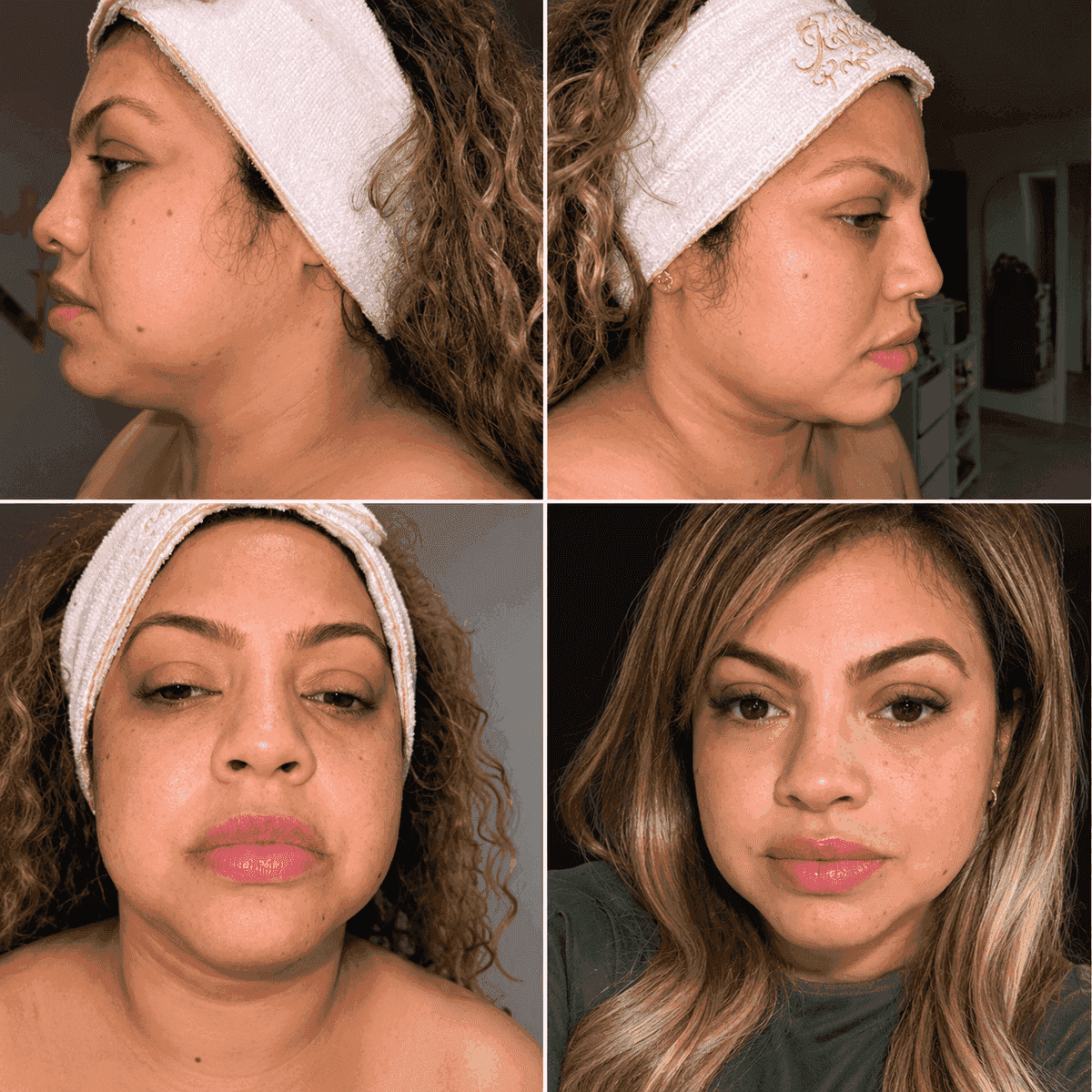 Antes y después — rejuvenecimiento y definición facial en mujer, Kzalon Cali