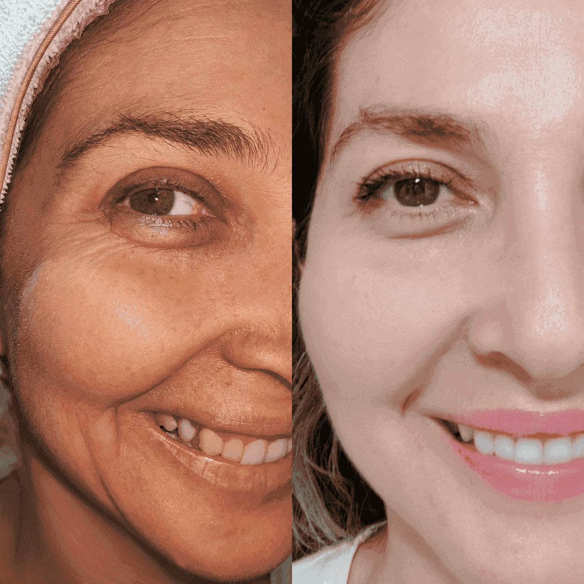 Tratamiento Fibroblast con Plasma Pen en Kzalon, Cali